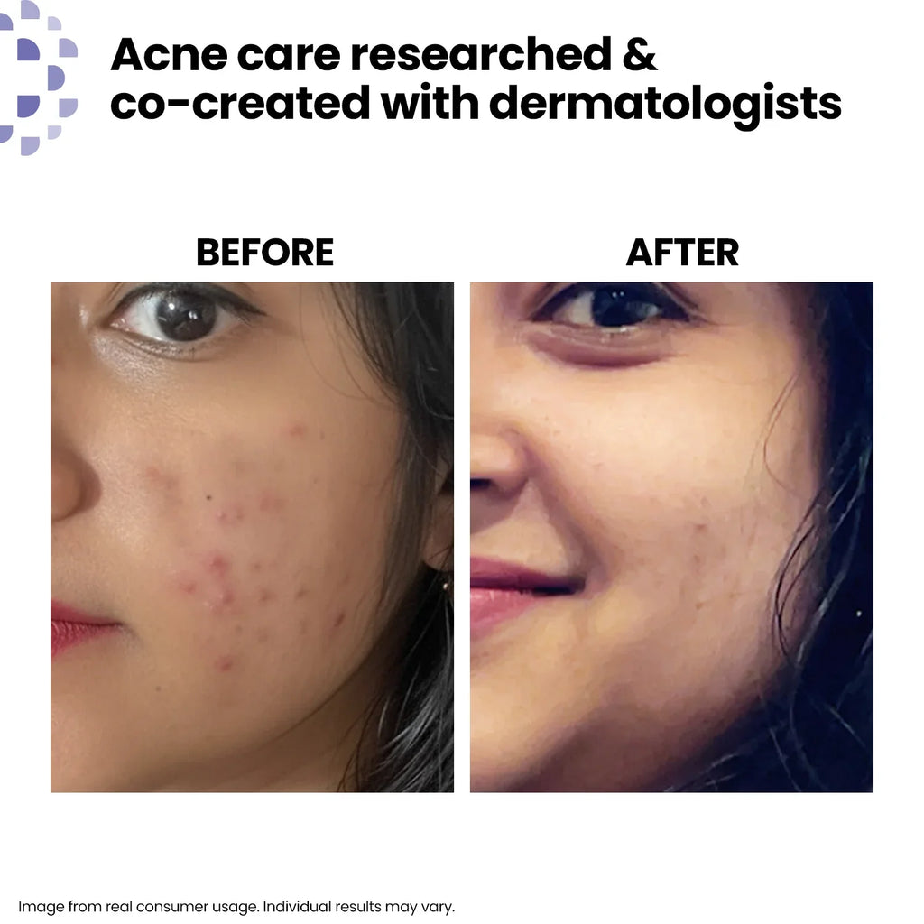 Salicylic Acid Purifying Cleanser | Acne Control Face Cleanser 100ml